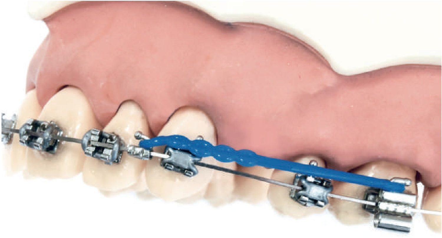 Specialty Archwires with Hooks and Bi-Dimensional Arches