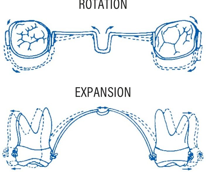 ROTATION — the bar can rotate the molar around its long axis
